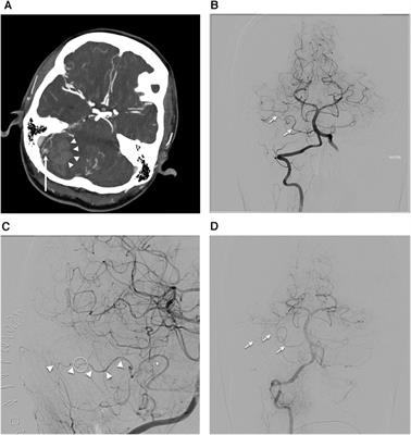 Continuous hemodynamics monitoring during arteriovenous malformation microsurgical resection with laser speckle contrast imaging: case report